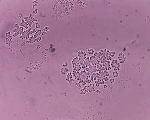 Microscopic fungi Malassezia furfur, showing yeast cells and hyphae. dermatophytes, Nail scraping...