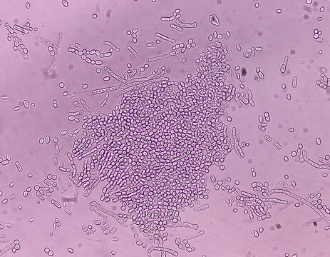 Microscopic fungi Malassezia furfur, showing yeast cells and hyphae. dermatophytes, Nail scraping or skin scraping for fungus test in microbiology laboratory.