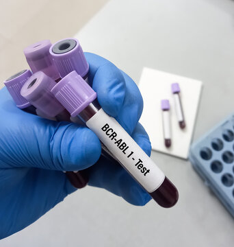 BCR-ABL 1 test is used to diagnose CML, a type of leukemia. BCR ABL Genetic Test.