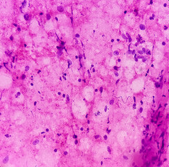 Neurofibromatosis. Neurofibroma (FNA Cytology), microscopic image show spindle shaped cells with...