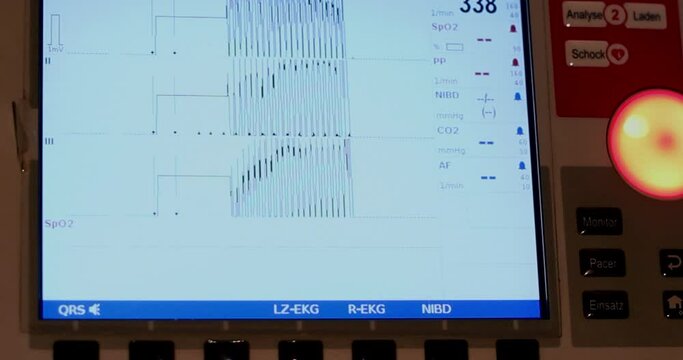 EKG showing a flatline, indicating heart failure in the hospital