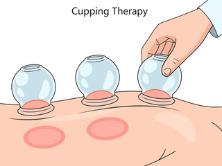 cupping therapy on skin, showcasing suction technique and resulting skin reaction diagram hand drawn schematic vector illustration. Medical science educational illustration - obrazy, fototapety, plakaty