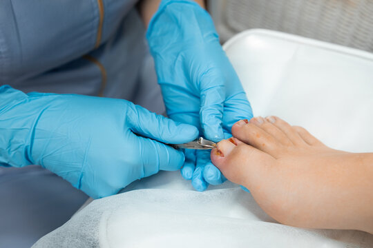 Podologist during the procedure of ingrown nail removal with clippers. 