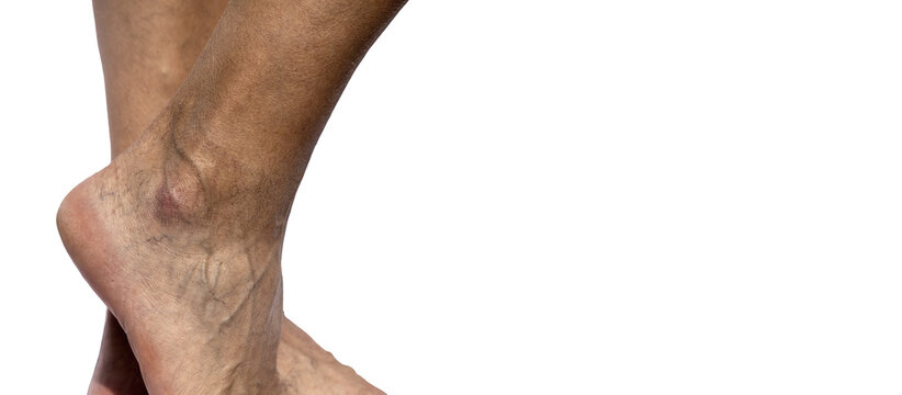 Legs of a person with vein disease and vascular problems . 