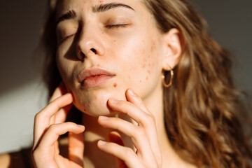Portrait of a beautiful young woman with rash skin, scar, and red skin syndrome allergic to...