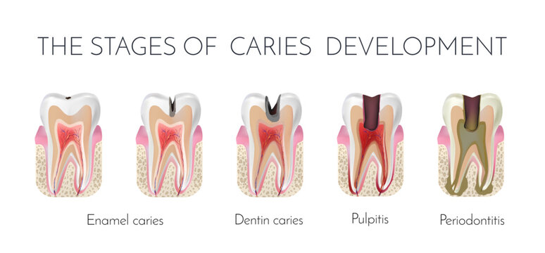 Tooth decay. The stages of caries development. Enamel and dentin caries, pulpits and periodontitis medical raster copy