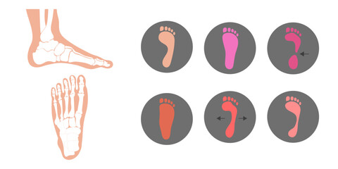 Types of deformity foot - obrazy, fototapety, plakaty