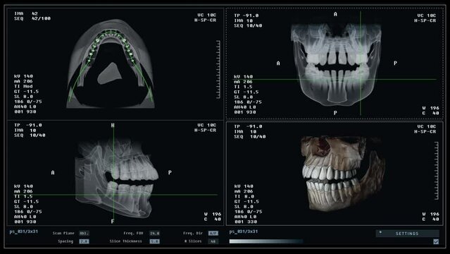 Reviewing multiple scans of an injured patient jaw at a dental health clinic. Monitoring dental health condition using skull scans. Examining the scans to check dental health. Analysis.