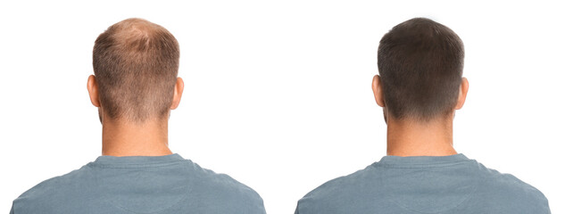 Man before and after hair treatment with high frequency darsonval device on white background, back...