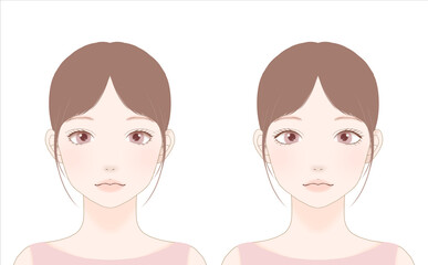 目尻切開の整形のBeforeとAfter