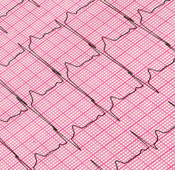 A fragment of a cardiogram. Cardiological examination