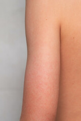 rash on a child's forearm. atopic dermatitis