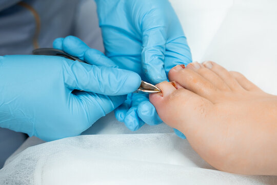 Podologist during the procedure of ingrown nail removal with nippers.