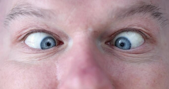 Young man with blue eyes squints. Correction of strabismus in adults concept