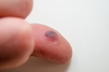 Blood blister under the thumb skin. Caucasian young man finger on white background