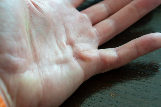 Dupuytren