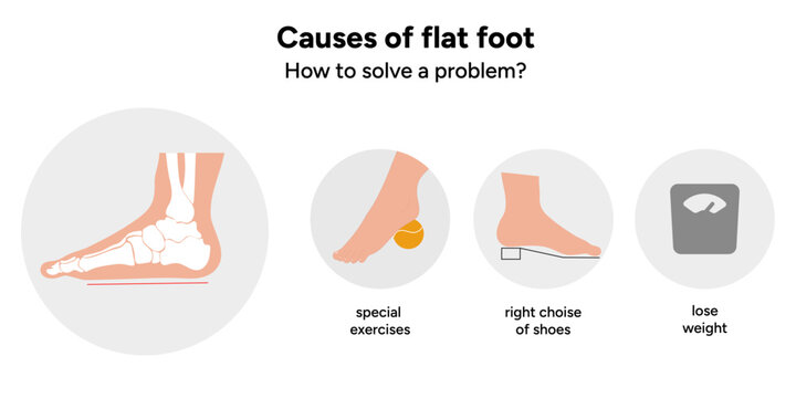 Causes of flat foot