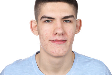 Obraz premium Young man with acne problem isolated on white