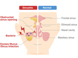 Comparative chart of how and why chronic sinusitis occurs