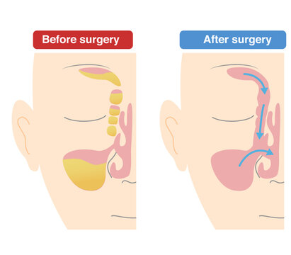 Comparative diagram of how Endoscopic Sinus Surgery;ESS is performed vs. preoperative