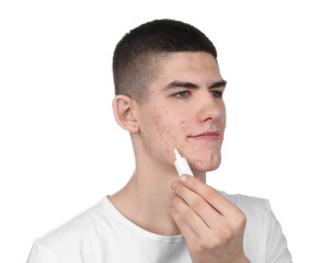 Young man with acne problem applying cosmetic product onto his skin on white background