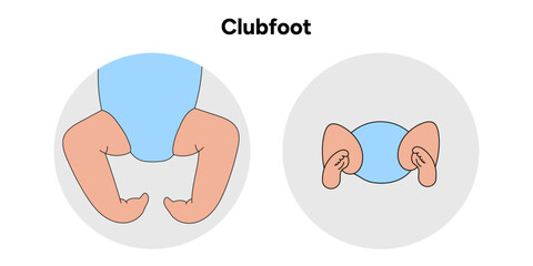 Clubfoot in baby’s 