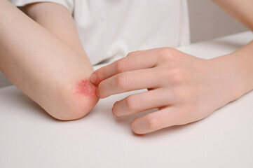Child suffers from dermatitis, scratches reddened, inflamed areas on his elbow with fingers,...