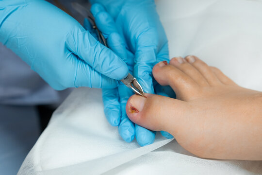  A podiatrist performs the procedure of ingrown nail removal using nippers. 
