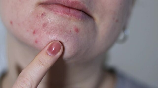 Close up of female face with red problematic acne skin