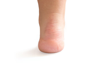 Foot with dry skin on white background, cracked heels. keratinized skin on the foot.