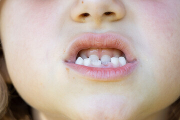 mouth of a 6-year-old girl with 2 baby teeth fallen out and the permanent ones showing