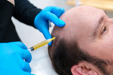 A clinician administers PRP injection to patient's scalp.