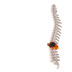 Human spine with disc herniation concept - 783251120