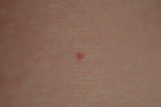 Mole Redness Spot Skin Texture Close-up 