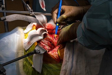 A group of surgeons remove a surgical operation to cut out a cancerous tumor or liver, kidney,...