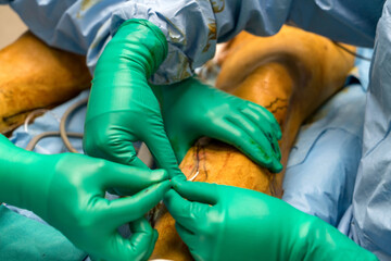Process of varicose vein surgery in hospital, vein sealing, venous vascular surgery, phlebectomy...