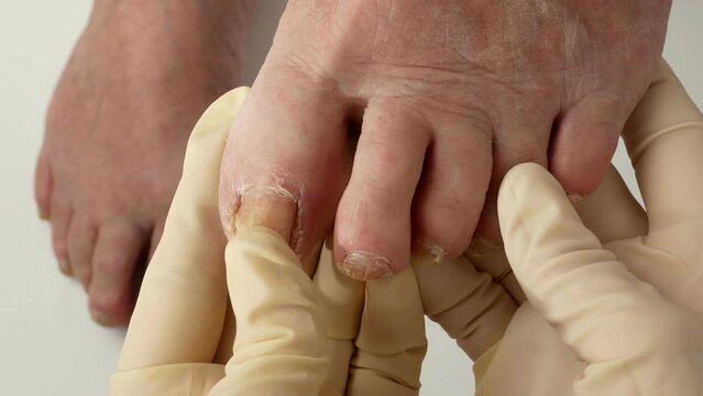 Toenail fungus. A podologist examines toenails affected by a fungal infection. Onycholysis of nails, Paramedicine, Medical pedicure, aging problems