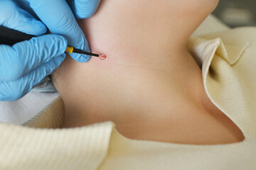 surgeon uses a radio wave knife to remove a neoplasm - a mole or nevus on the neck of a female patient.