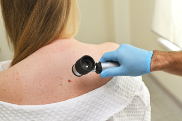 dermatologist oncologist uses a dermatoscope to examine moles and birthmarks on the patient's body. Melanoma Day, Skin Cancer