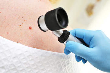 a dermatologist examines moles and skin growths on the patient's body using a special device - a dermatoscope. Diagnosis and prevention of melanoma. - obrazy, fototapety, plakaty