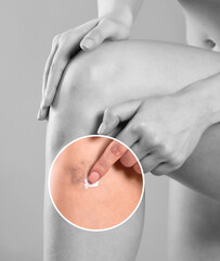 A girl applies healing ointment to a bruise on her knee. Close-up of a bruise on a woman's leg.