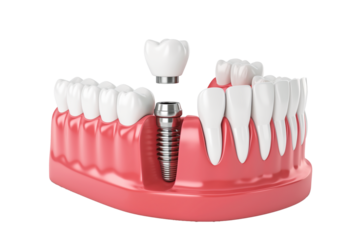Jaw with teeth and premolar implants on a transparent background