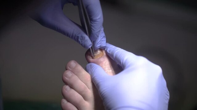 The podologist scrapes the nail with a buffing attachment