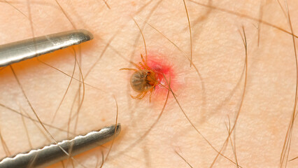 Close-up of tick embedded in human skin being removed with tweezers, illustrating importance of timely response to insect bites for disease prevention.