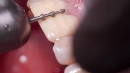 Close-up shot of removing partly teeth enamel by dental diamond bur. Dentist preparing woman's teeth for installing zirconia veneers and crowns using the dental bur. Dentistry, prosthetics concept.
