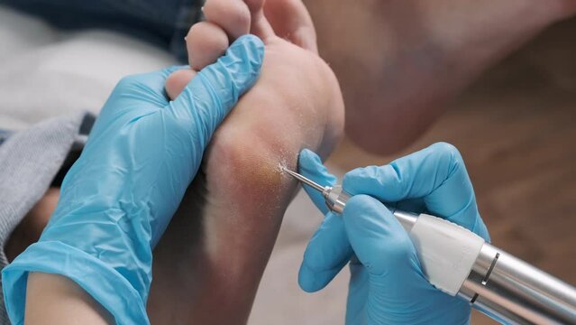 Close up callus removal from a woman's foot is performed by a podiatrist using an electric drill
