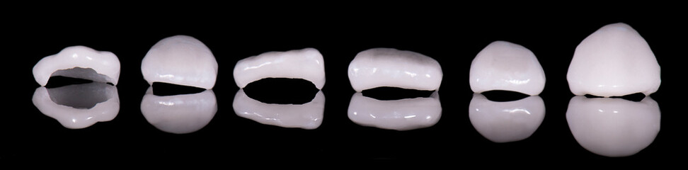 emax ceramic veneers