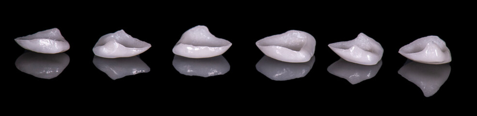 emax ceramic veneers