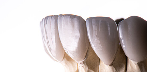 Obraz premium emax ceramic veneers