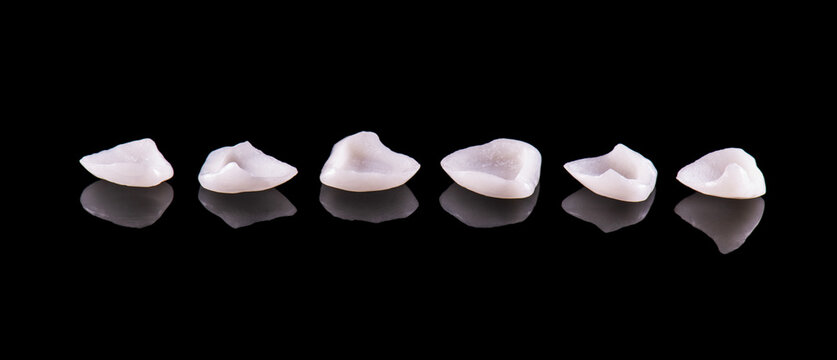emax ceramic veneers